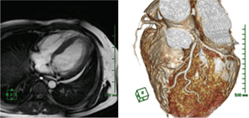 心臓MRIの写真