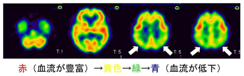脳血流SPECT検査の写真