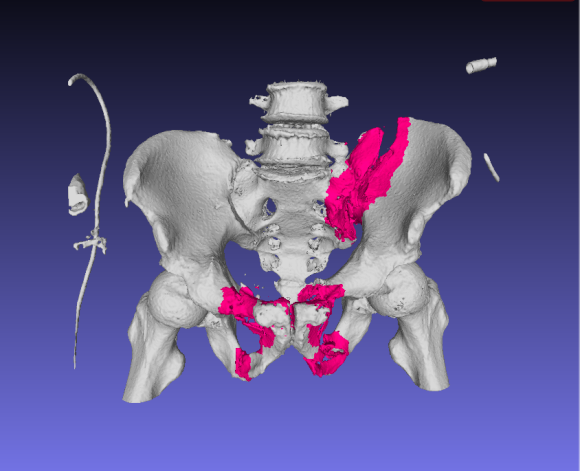 Vol.1: 骨盤骨折をみつける人工知能できました！